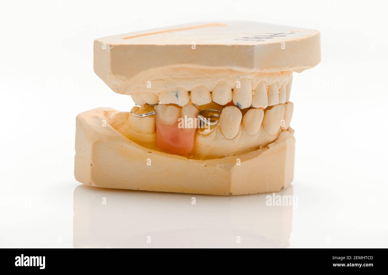 Set of pictures with a Partial denture cast and denture showing missing teeth gaps on a white background with reflection. Stock Photo