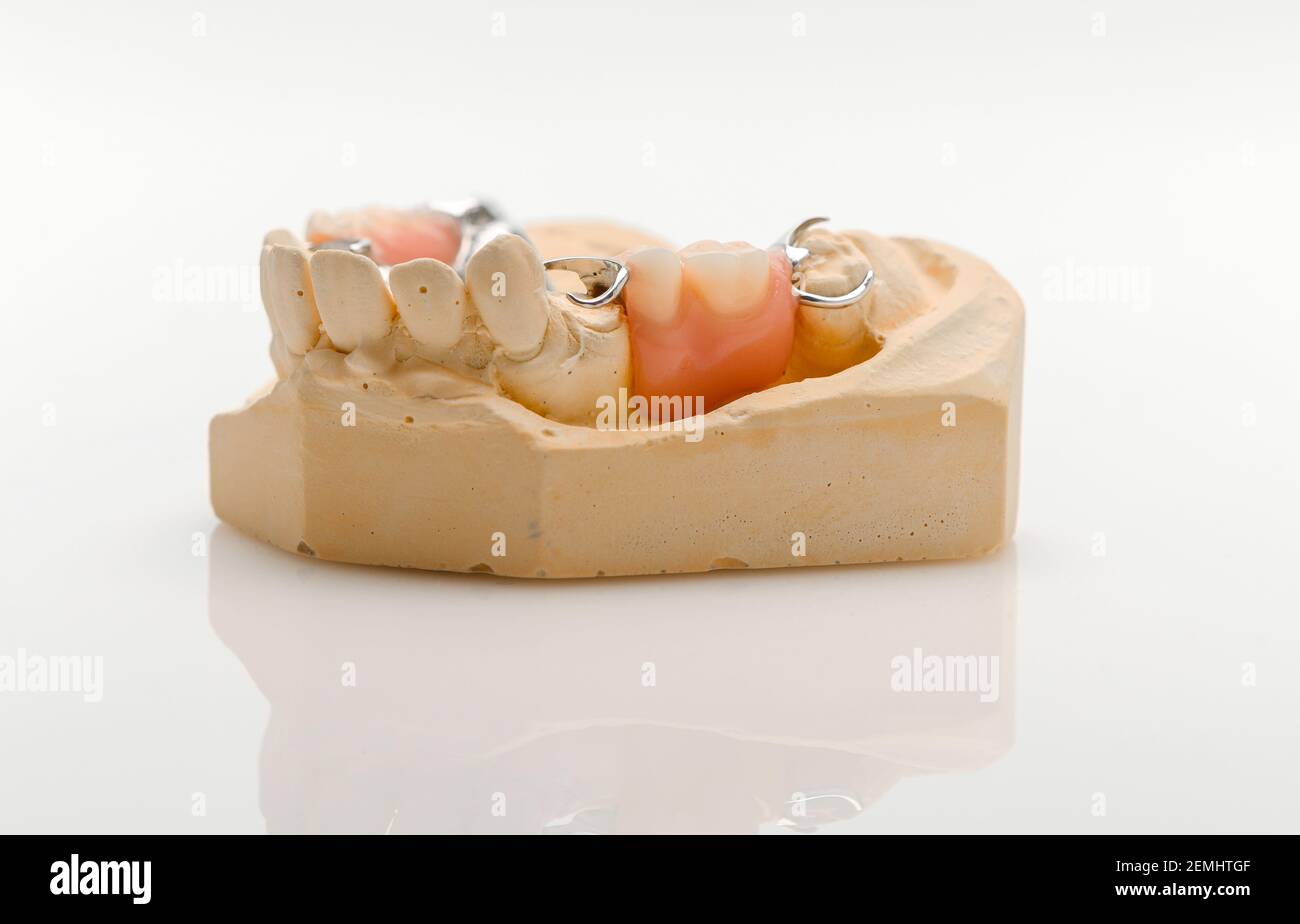 Set of pictures with a Partial denture cast and denture showing missing teeth gaps on a white background with reflection. Stock Photo