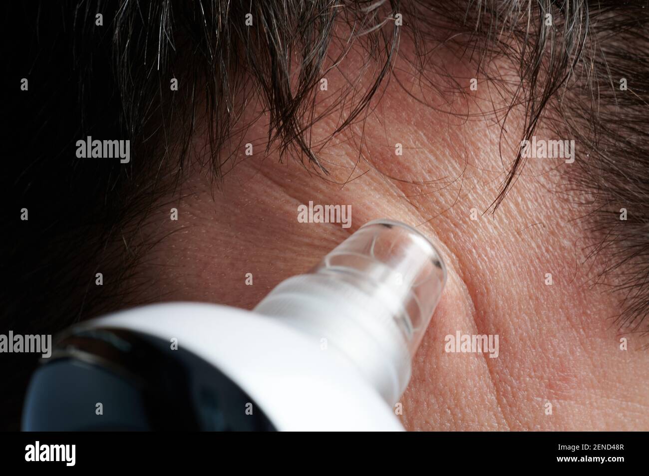 Cleaning forehead skin from blackheads macro close up view Stock Photo