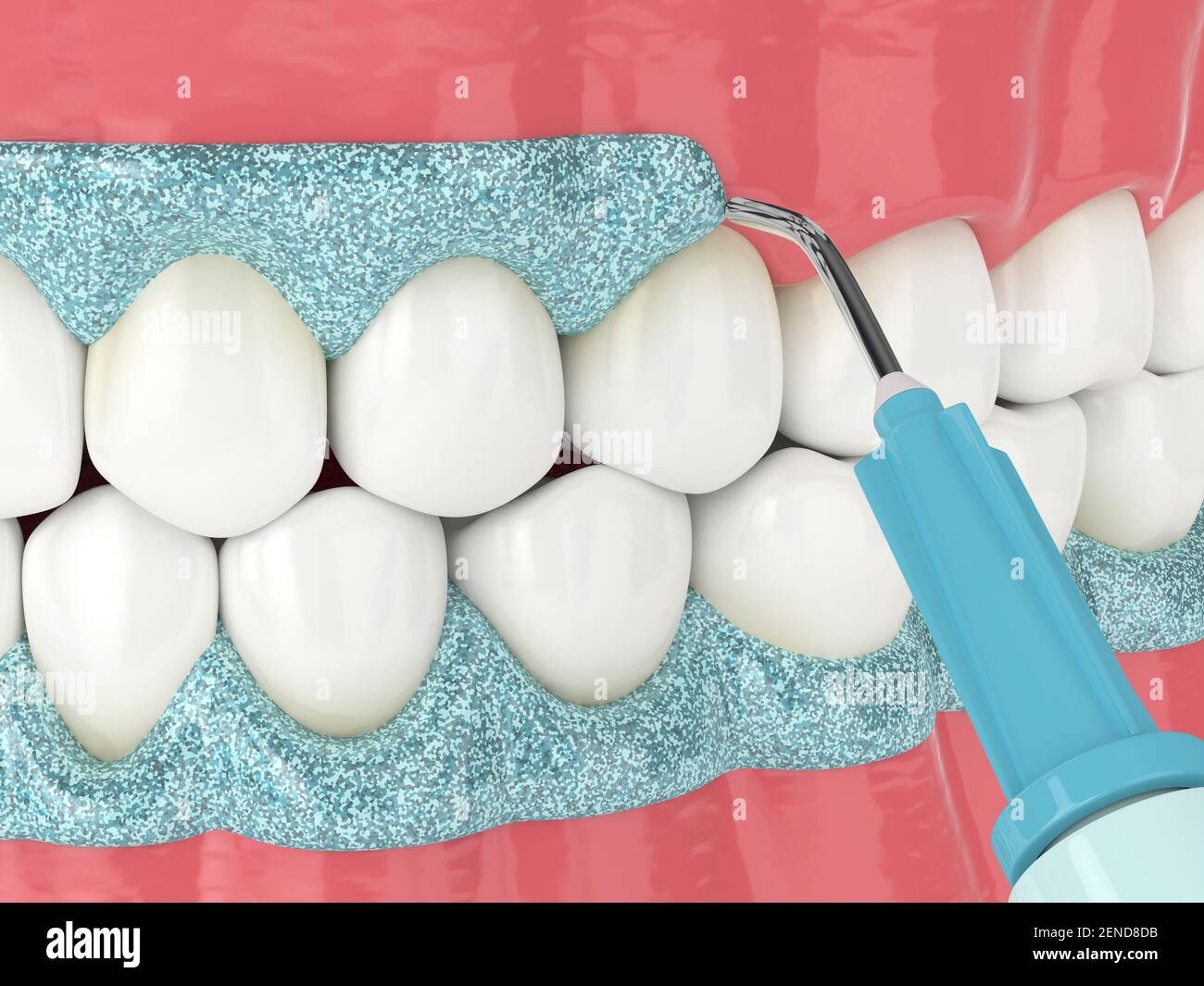 3d render of jaw with gingival mask before teeth bleaching. Protecting the gums before teeth