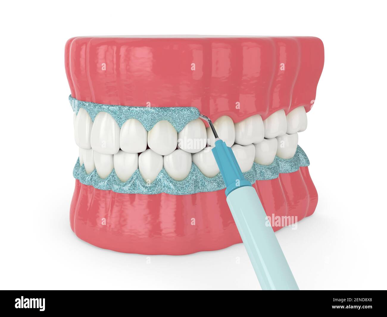 3d render of jaw with gingival mask before teeth bleaching. Protecting
