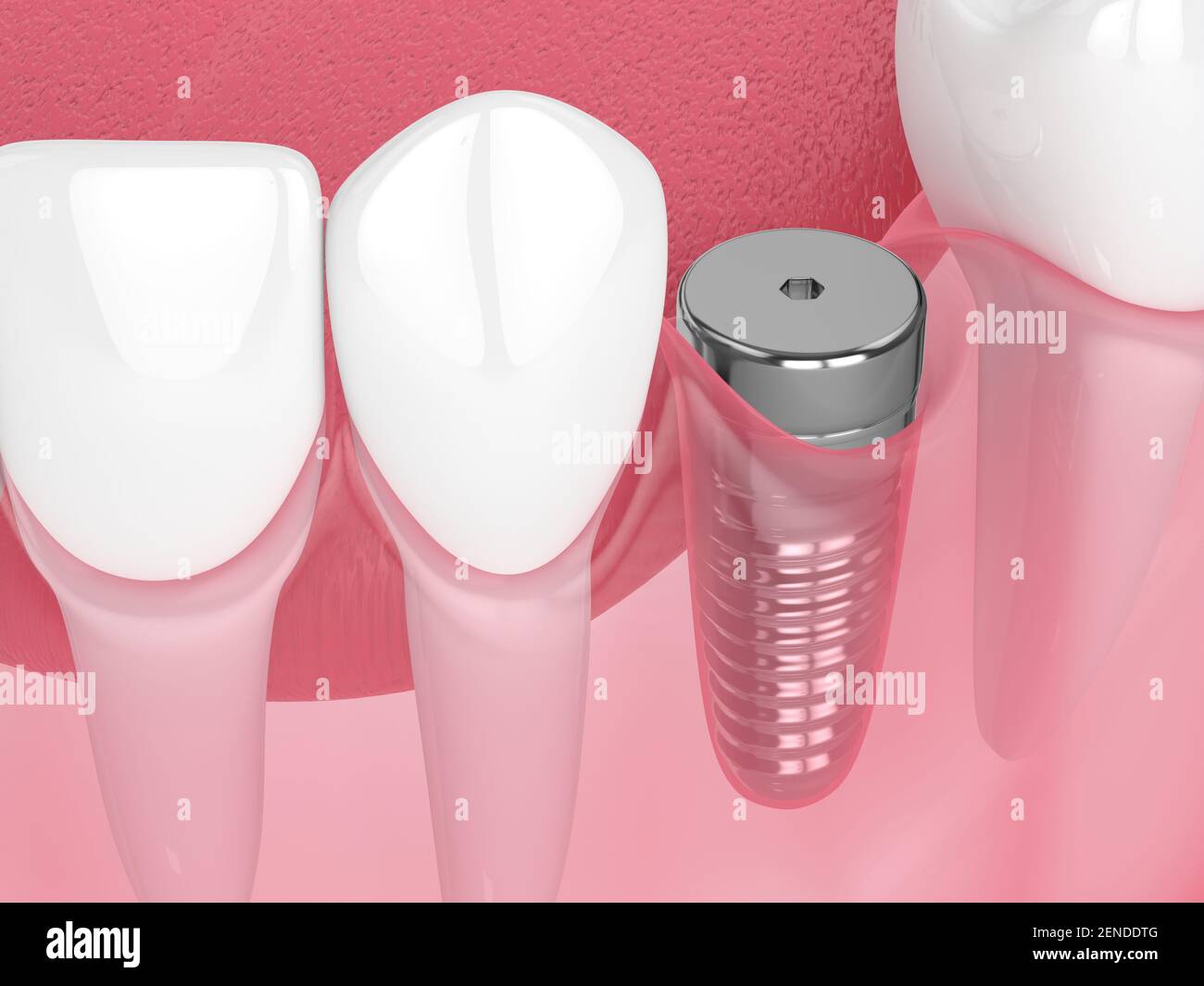 3d render of jaw with implant screw and healing cap. Dental