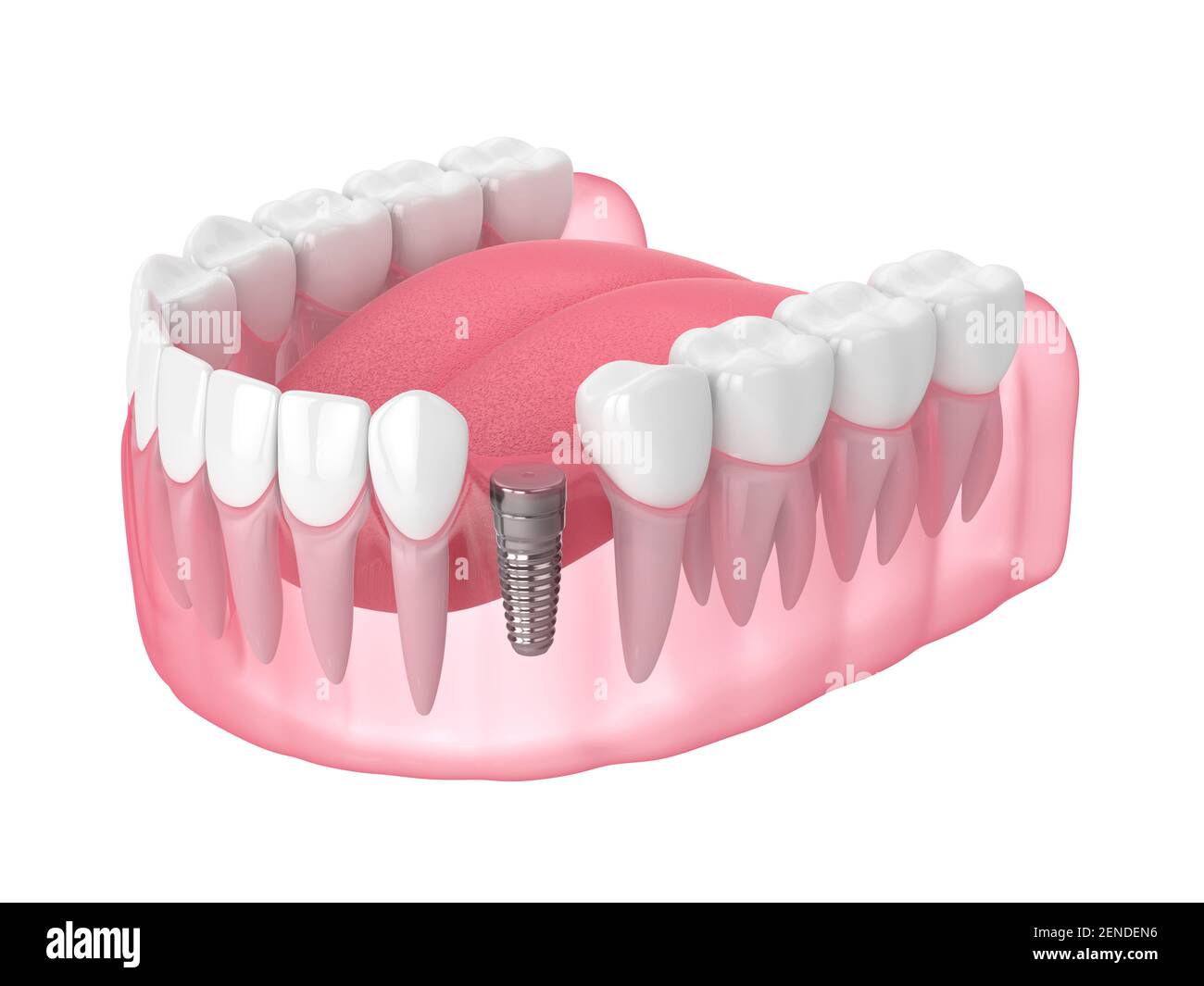 3d render of jaw with implant screw and buried healing cap under gums