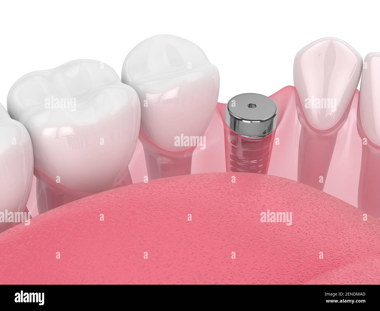 3d render of jaw with implant screw and healing cap. Dental