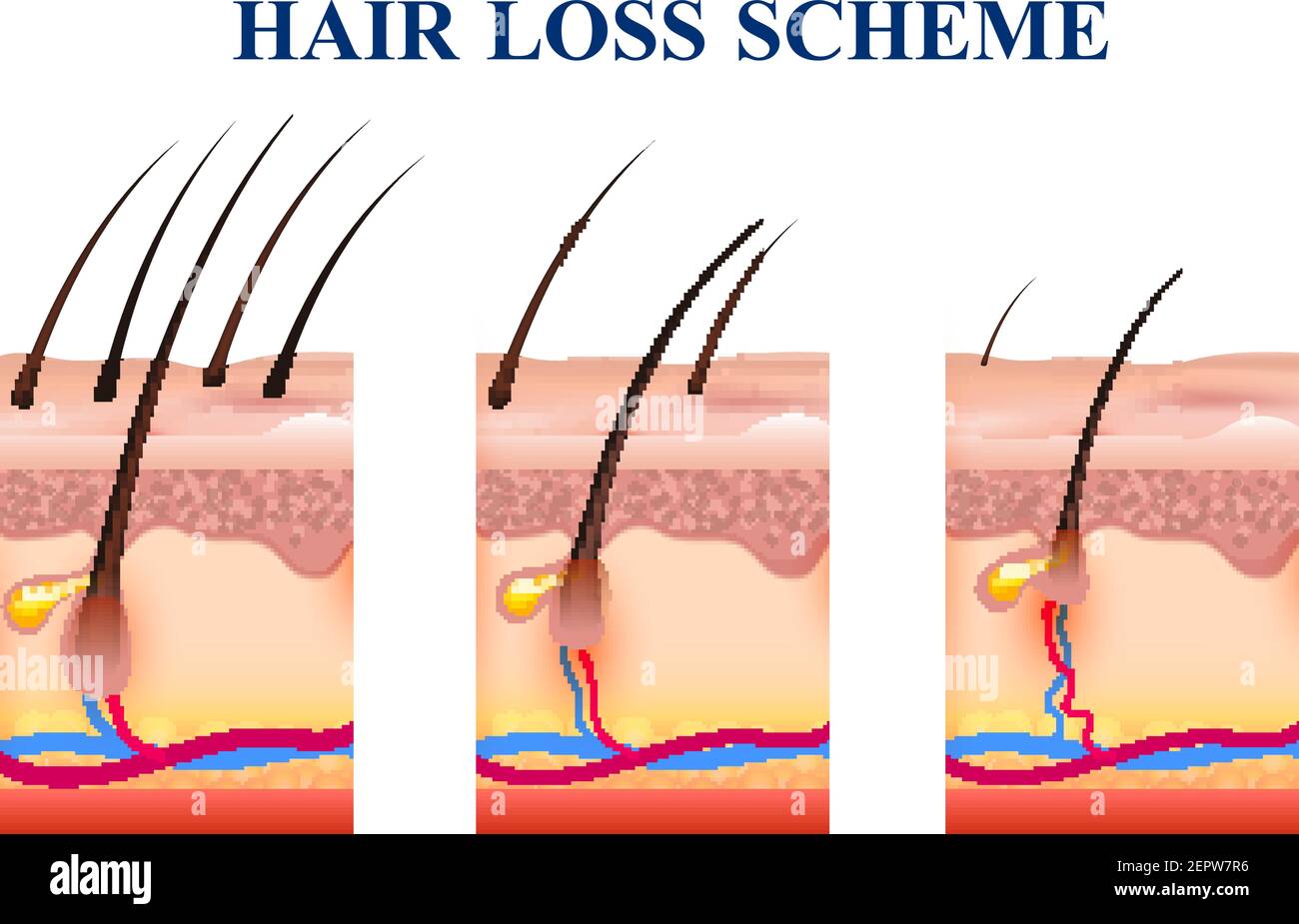 Stages of hair loss on human skin, scheme with anatomy structure including  follicles, veins, nerves, vector illustration Stock Vector Image & Art -  Alamy