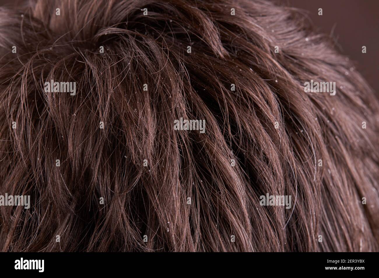 male person with dandruff disease. dermatology health care Stock Photo