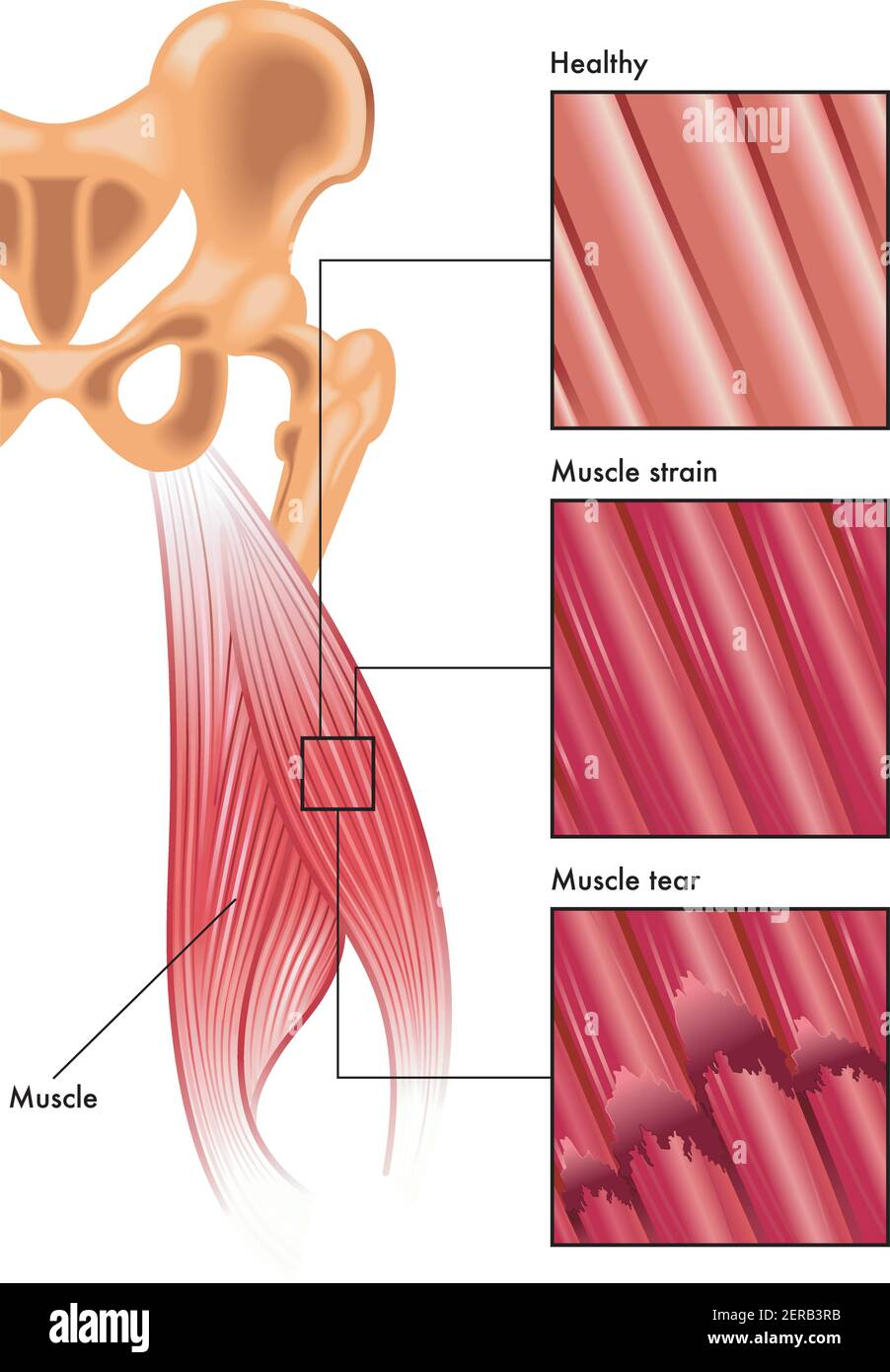 Medical illustration shows healthy muscle fibers compared to muscle strain and muscle tear. Stock Vector