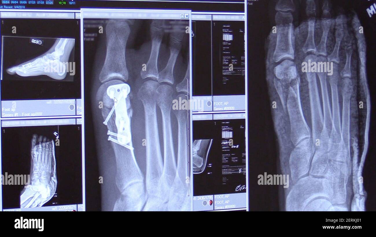 An Xray shows damage to Jessica Woodington's foot, right, and the