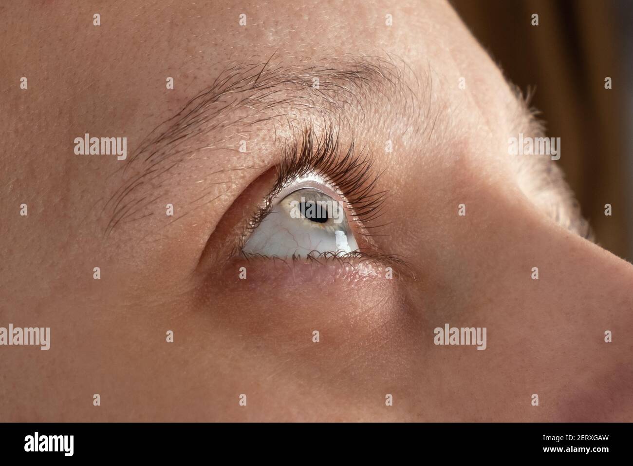 woman eye with corneal dystrophy, keratoconus, thinning of the cornea Stock Photo