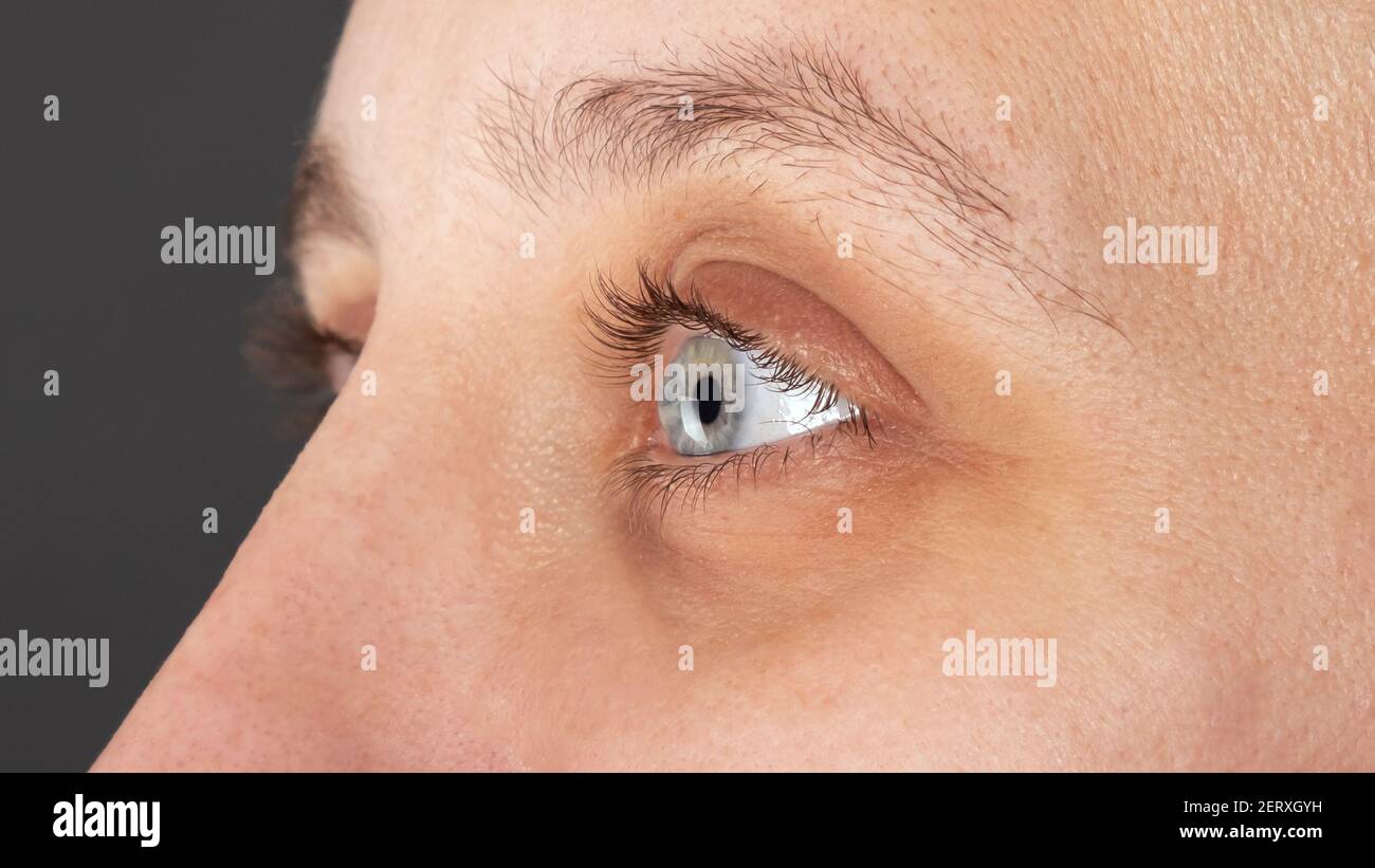 female eye diagnosed with keratoconus,corneal dystrophy Stock Photo