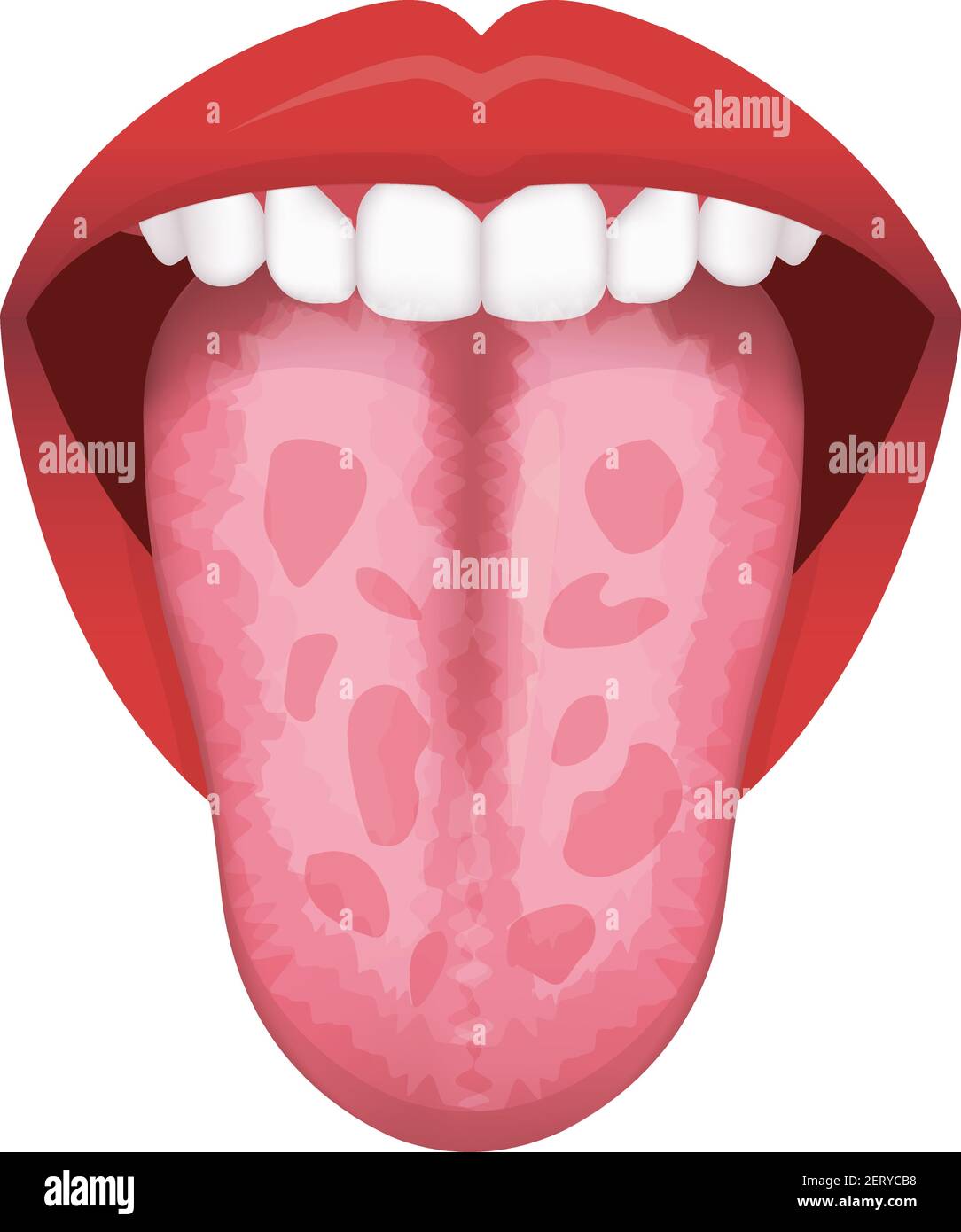 Tongue’s health sign vector illustration ( Geographic Tongue ) Stock Vector