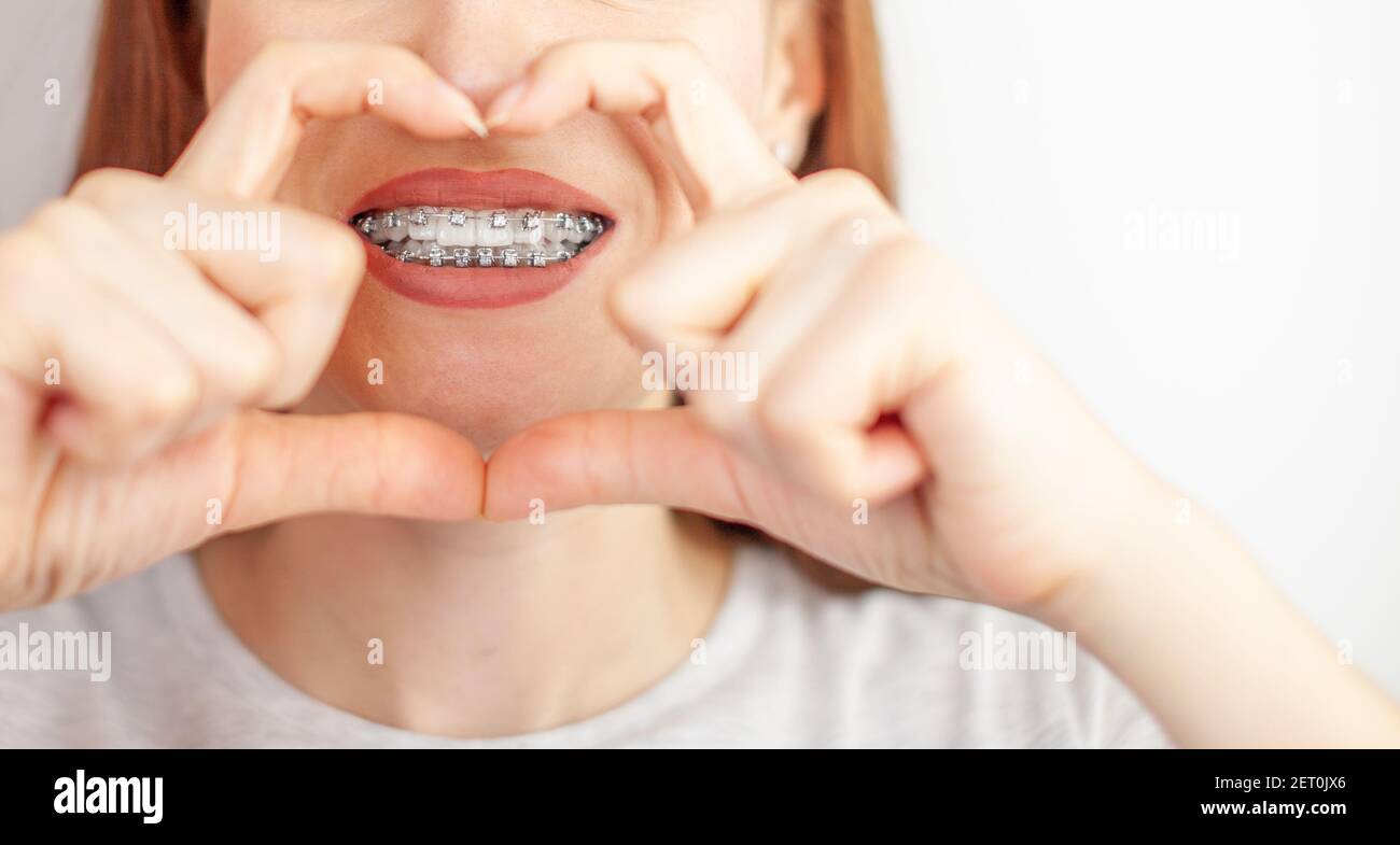A beautiful woman with braces on her white teeth through a frame from her hands. Straightening and dental hygiene. Dental care. Stock Photo