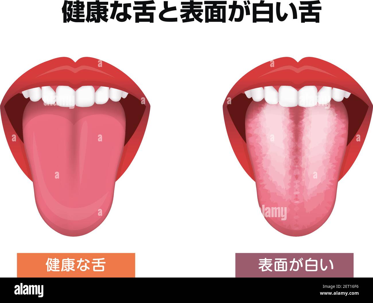 Tongue’s health sign vector illustration ( White coated tongue ) Stock Vector