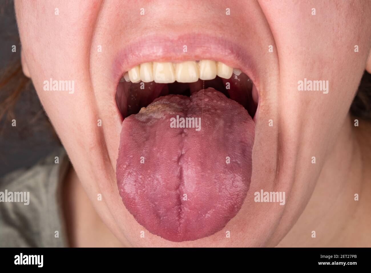 stomatitis inflammation of the tongue, cancer of the tongue Stock Photo