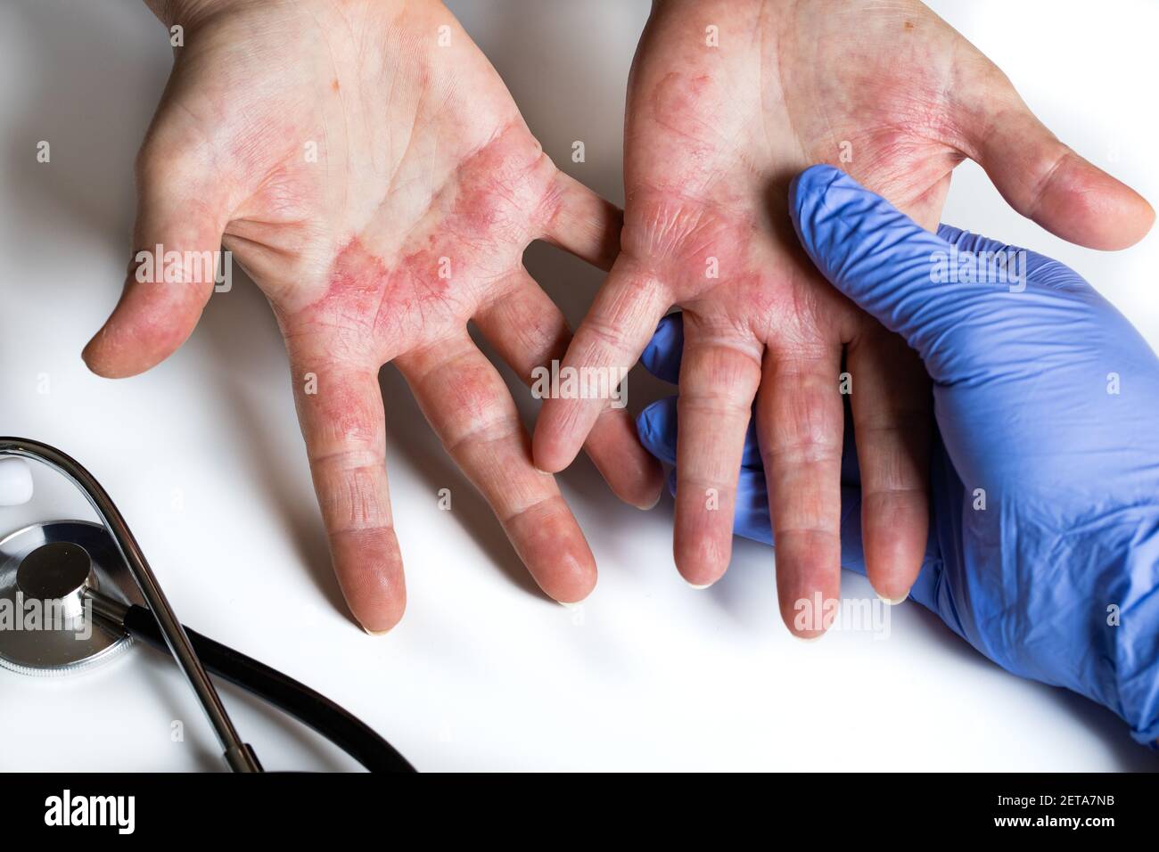 Atopic dermatitis. Red, itchy hands with blisters seen by a dermatologist wearing rubber gloves