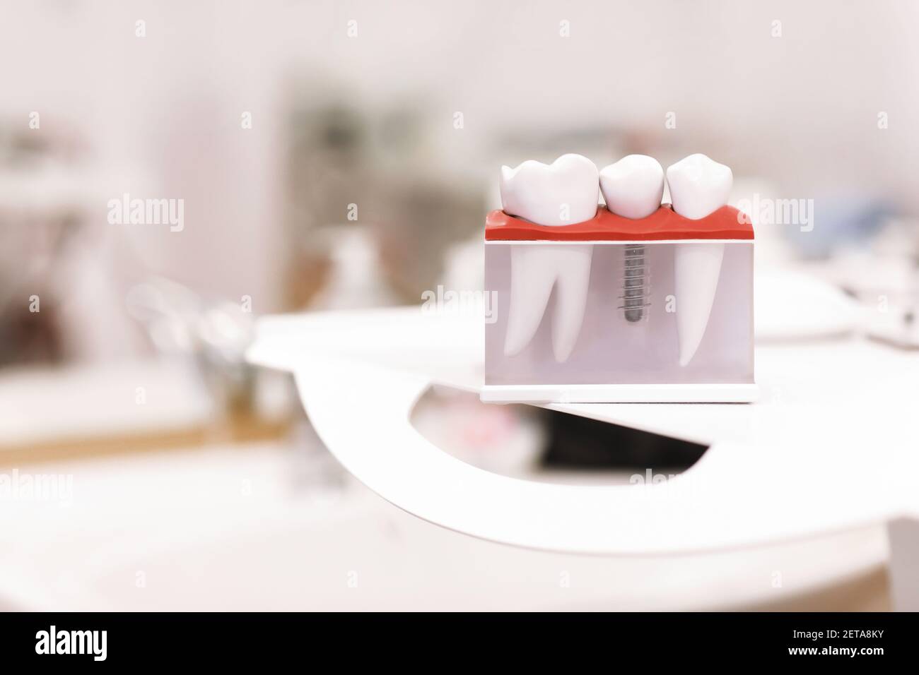 Dentist dental teeth teaching model showing titanium metal tooth