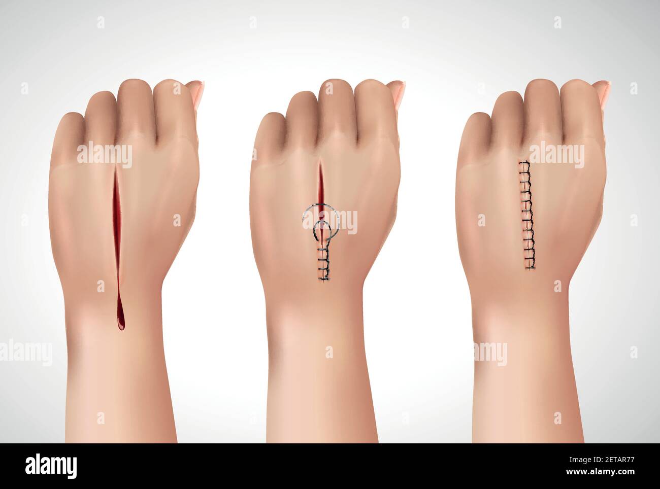 Surgical suture stitches realistic composition with isolated images of human hand at different stages of stitching vector illustration Stock Vector