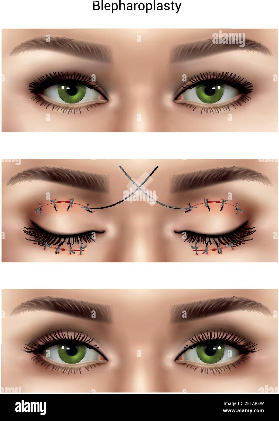 Surgical suture stitches realistic composition with images of female eyes at different stages of blepharoplasty procedures vector illustration Stock Vector