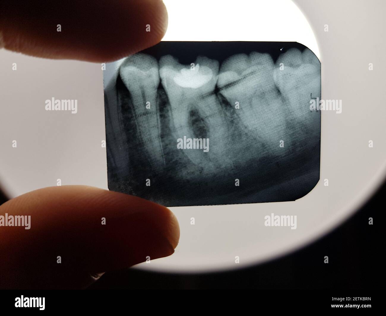 The result of x-ray radiography of the teeth of the oral cavity of the patient to be treated in dentistry Stock Photo