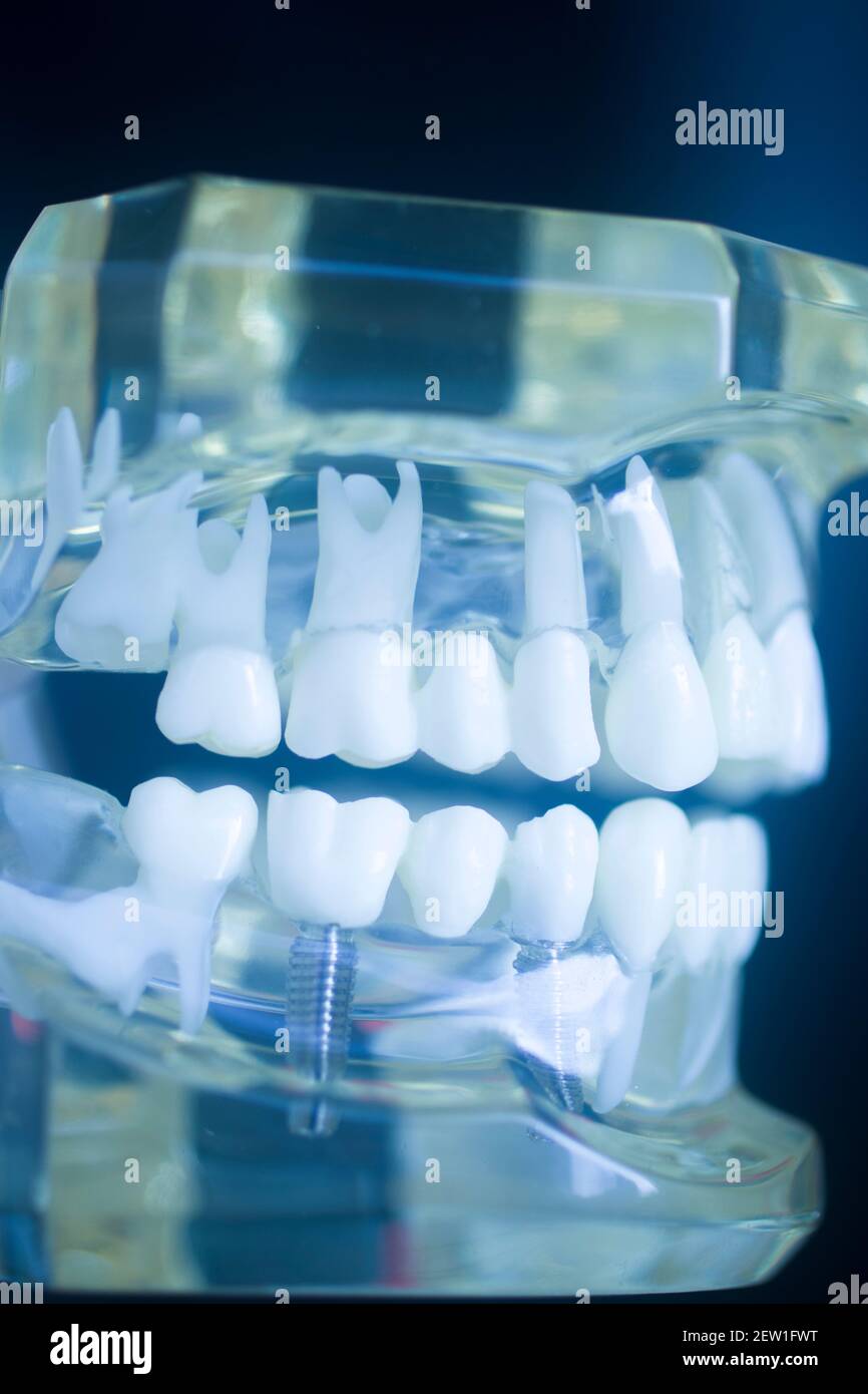 Define The Dental Model Cast And Explain Its Use In Dentistry At Anita Define The Dental Model Cast And Explain Its Use In Dentistry At Anita