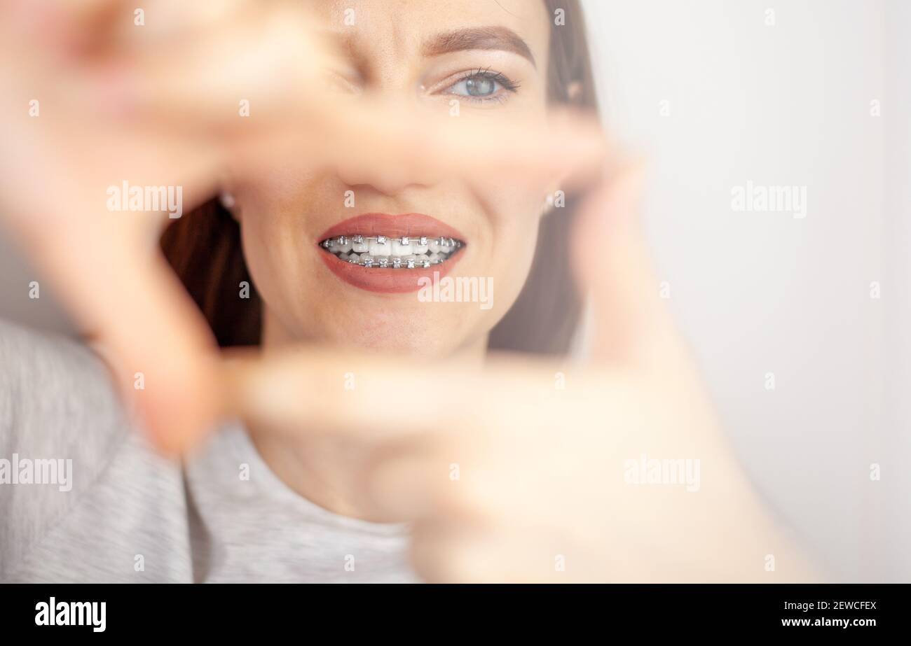 A beautiful woman with braces on her white teeth through a frame from her hands. Straightening and dental hygiene. Dental care. Stock Photo