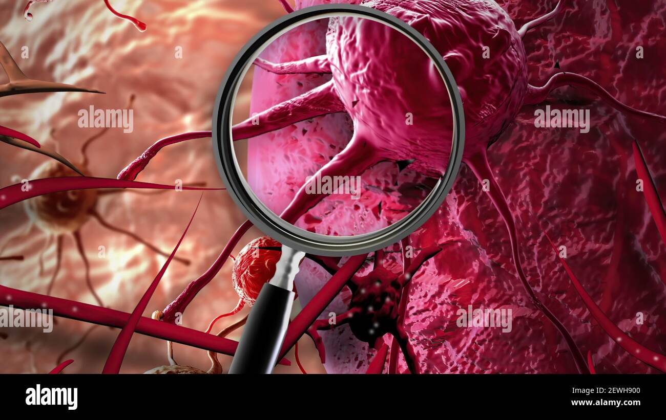 3D illustration - Concept of Cancer Cell in human body Stock Photo - Alamy