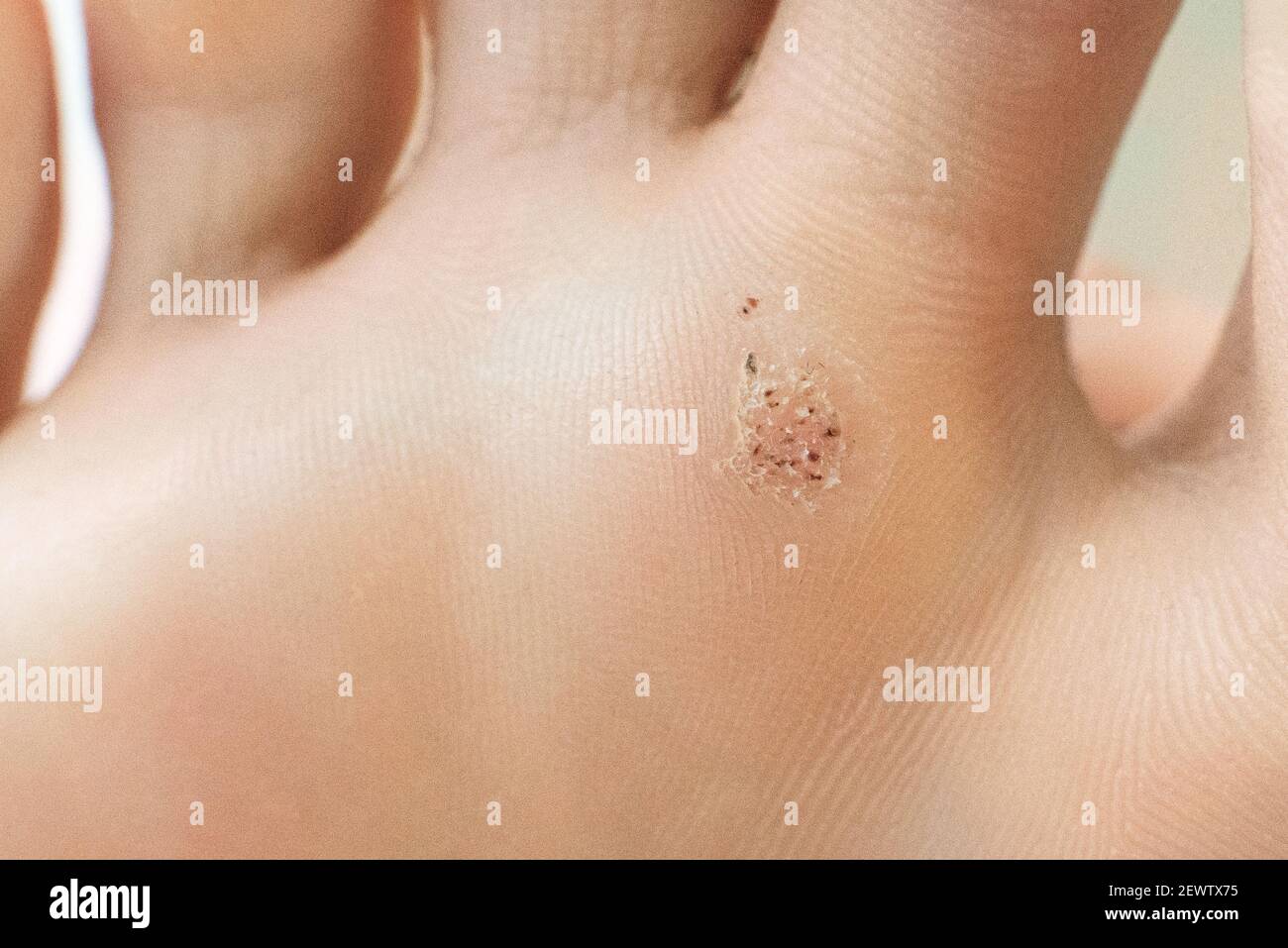 wart on a blunt close-up. Macro shot of human papilloma on the foot Stock Photo