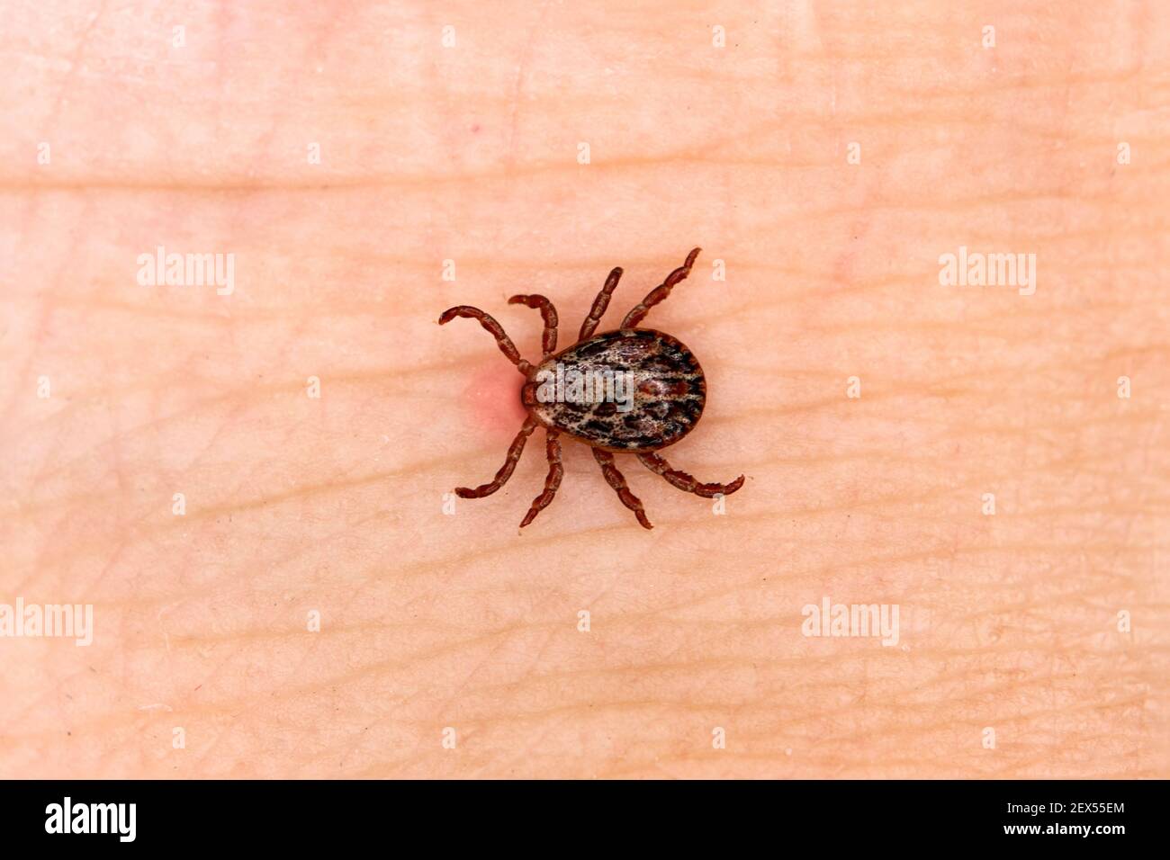 sucking tick, sucking on a human. Tick on the skin background. Dermacentor reticulatus Stock Photo