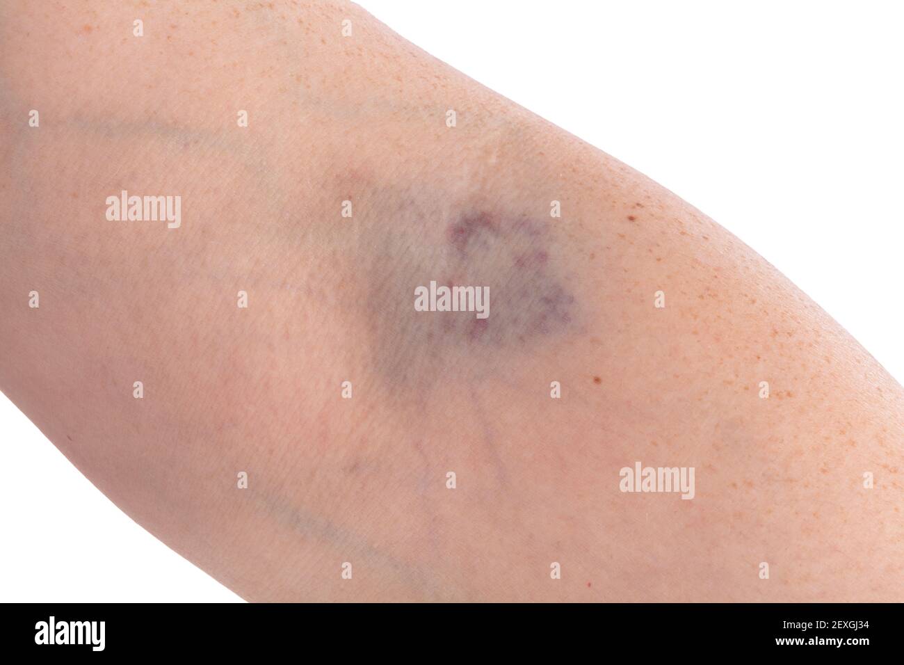 Hematoma arm hires stock photography and images Alamy