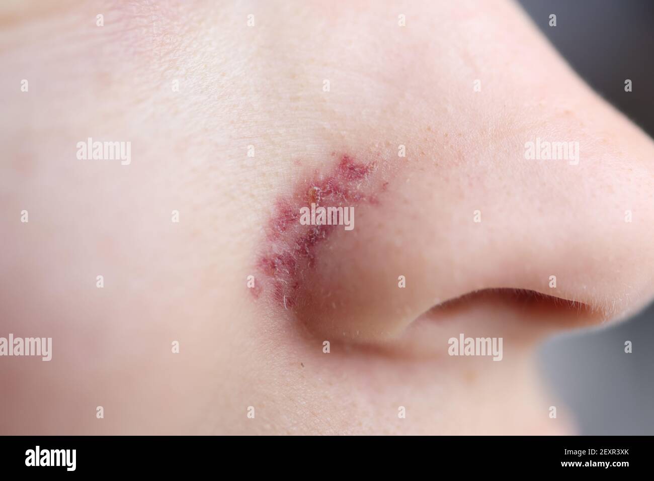 Inflamed dermatitis hi-res stock photography and images - Alamy