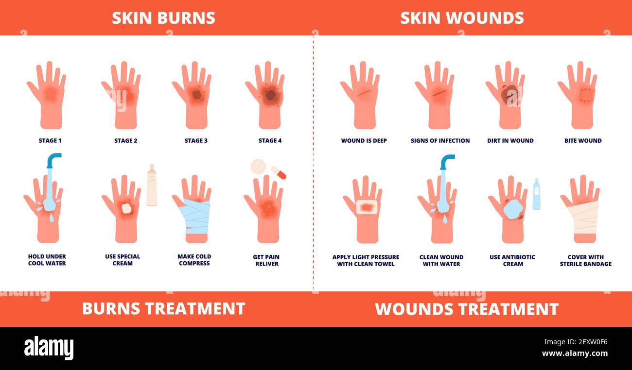 Skin first aid. Burns treatment, wounds and trauma symptoms. Degree burn, help hand healing with cream, bandaging and pills vector poster. Injury skin and wound care, treatment hurt illustration Stock Vector