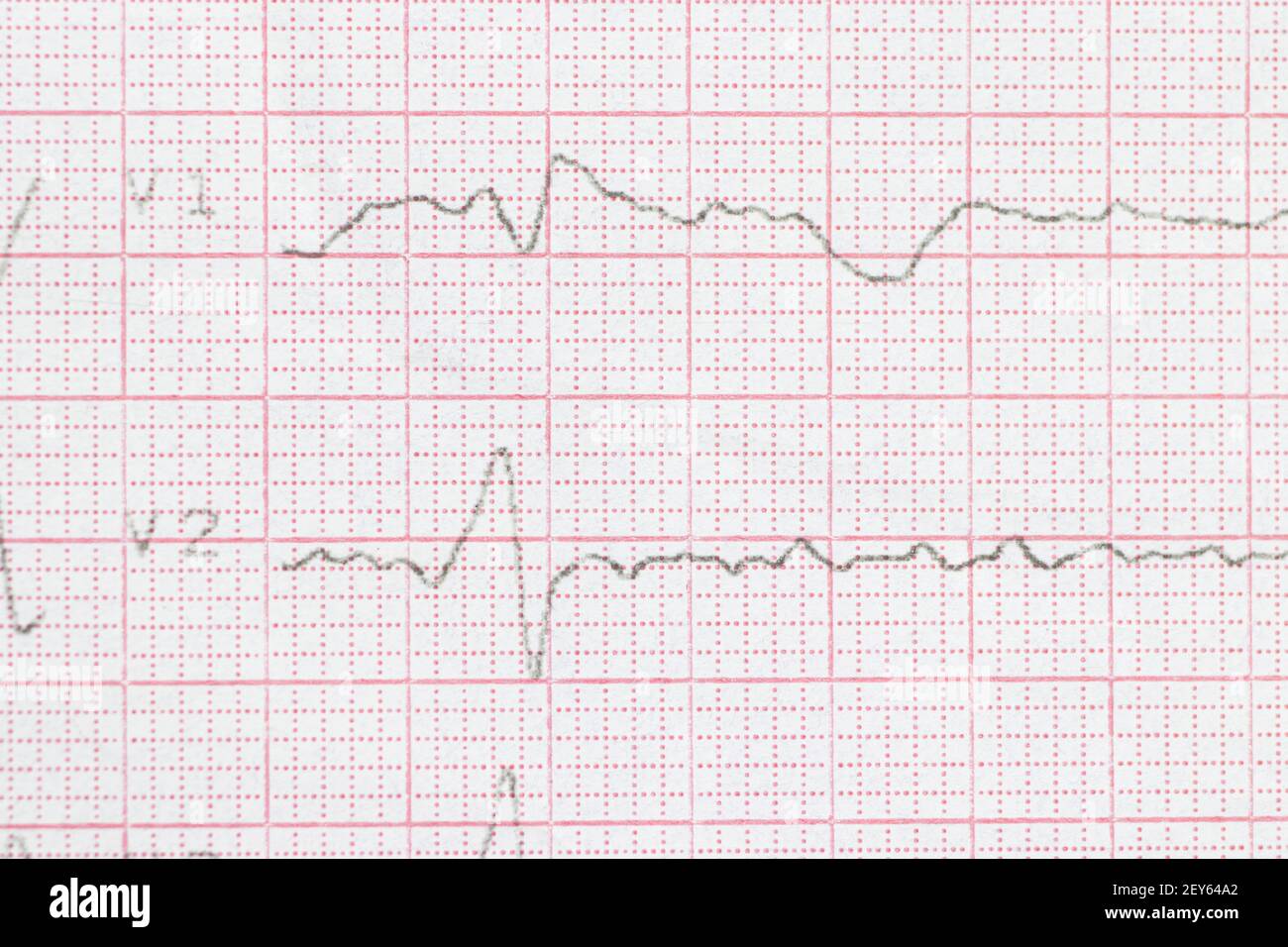 Bundle Branch Block High Resolution Stock Photography And Images Alamy