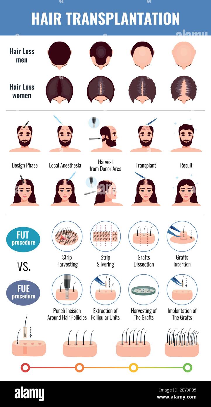 Baldness of men and women methods of hair transplantation set with infographic elements isolated vector illustration Stock Vector