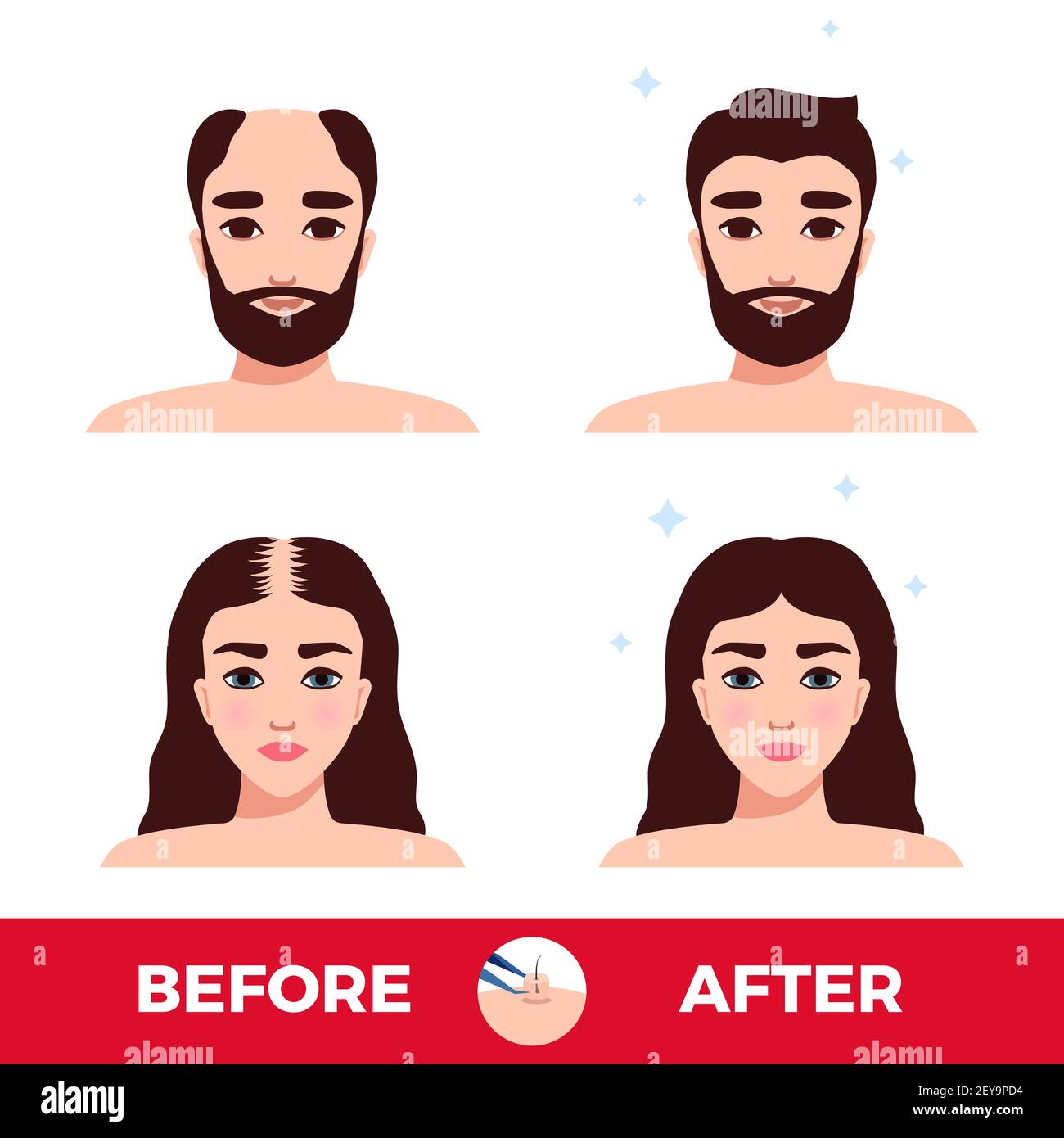 Man and woman before and after hair transplantation on white background flat vector illustration Stock Vector