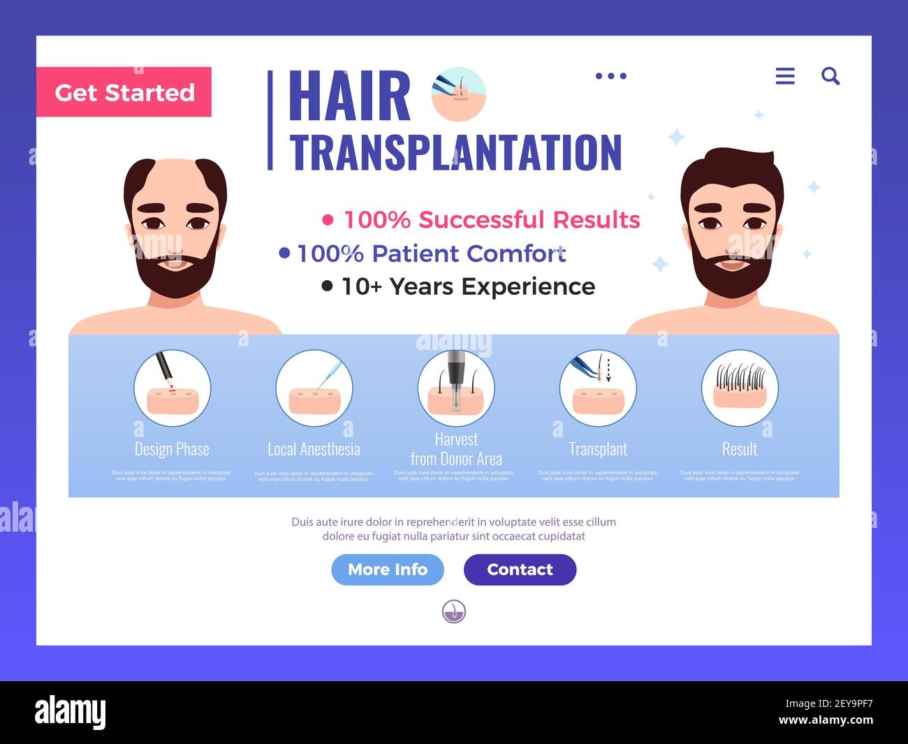 Hair transplantation web banner with infographics advertising and interface elements on white background vector illustration Stock Vector