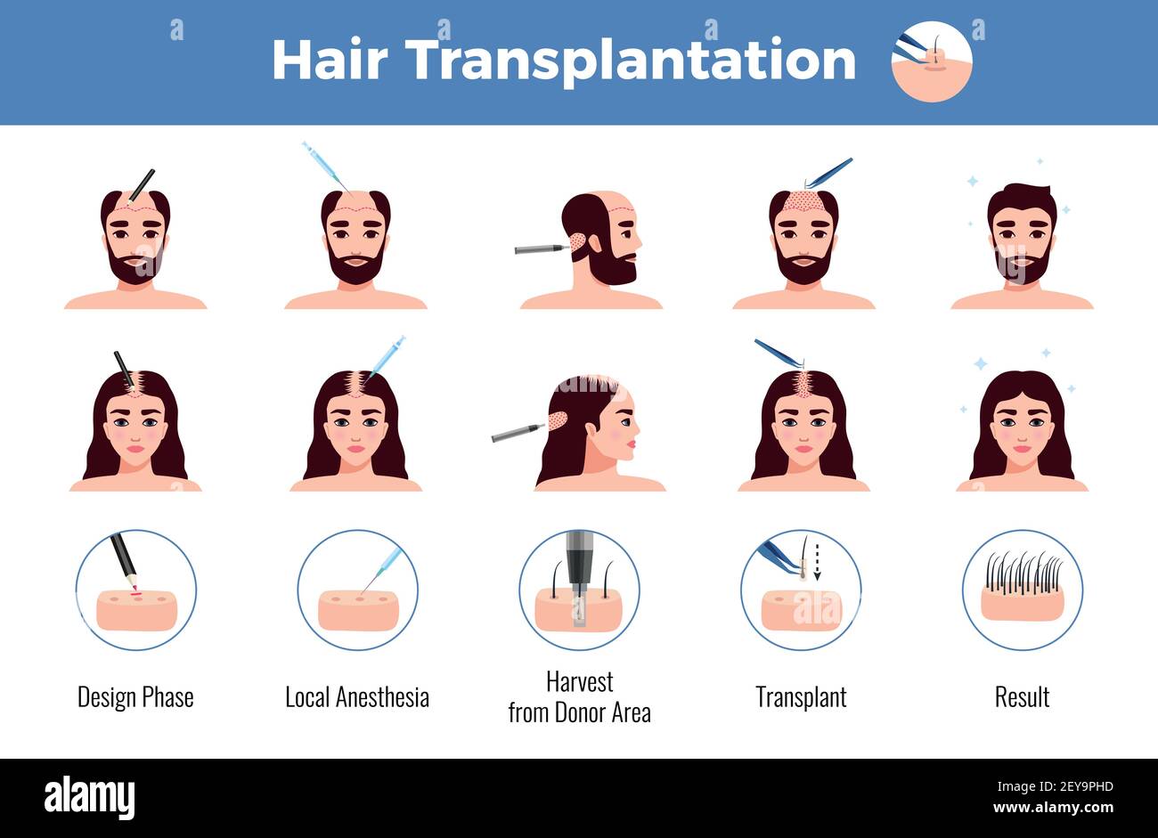 Hair transplantation for men and women with stages of operation infographics on white background vector illustration Stock Vector