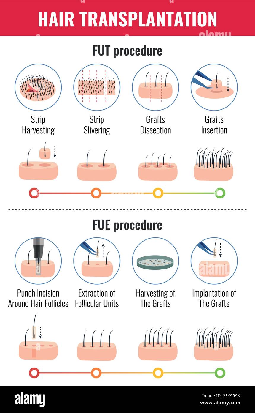 Methods of hair transplantation with stages of procedure infographics on white background vector illustration Stock Vector