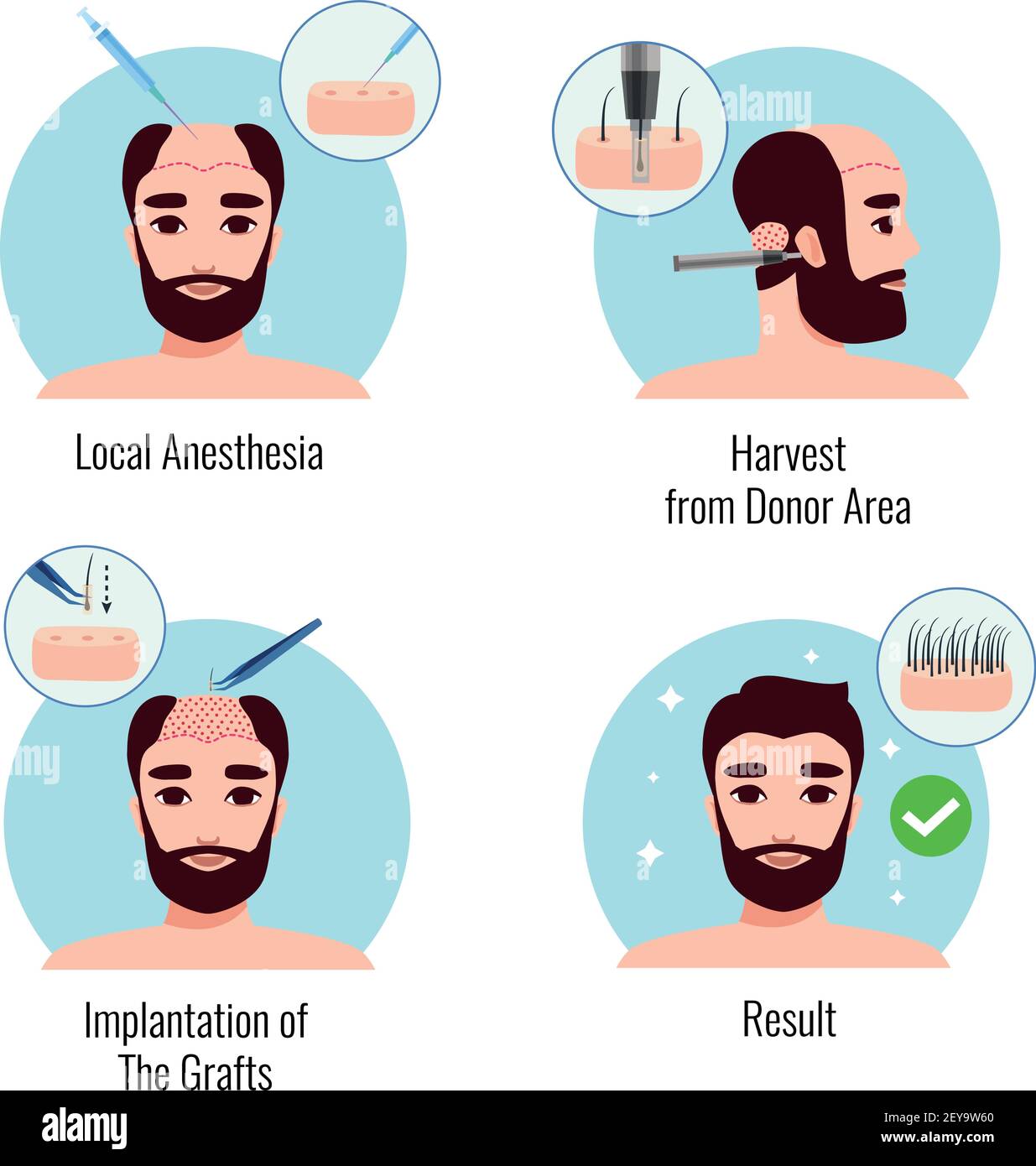 Design concept with bearded man on stages of hair transplantation procedure isolated vector illustration Stock Vector