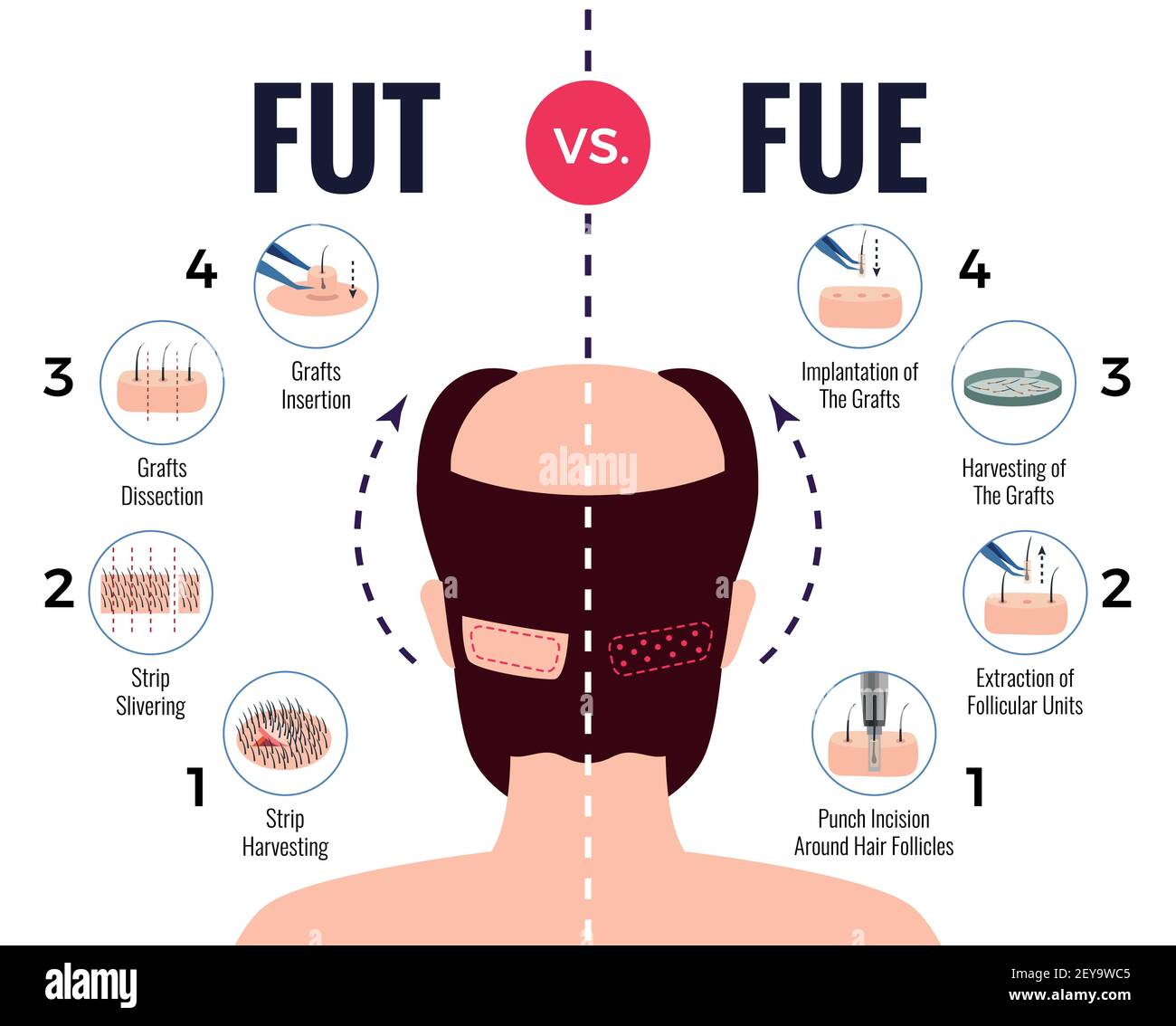 Methods of hair transplantation fut vs fue poster with infographic elements on white background vector illustration Stock Vector