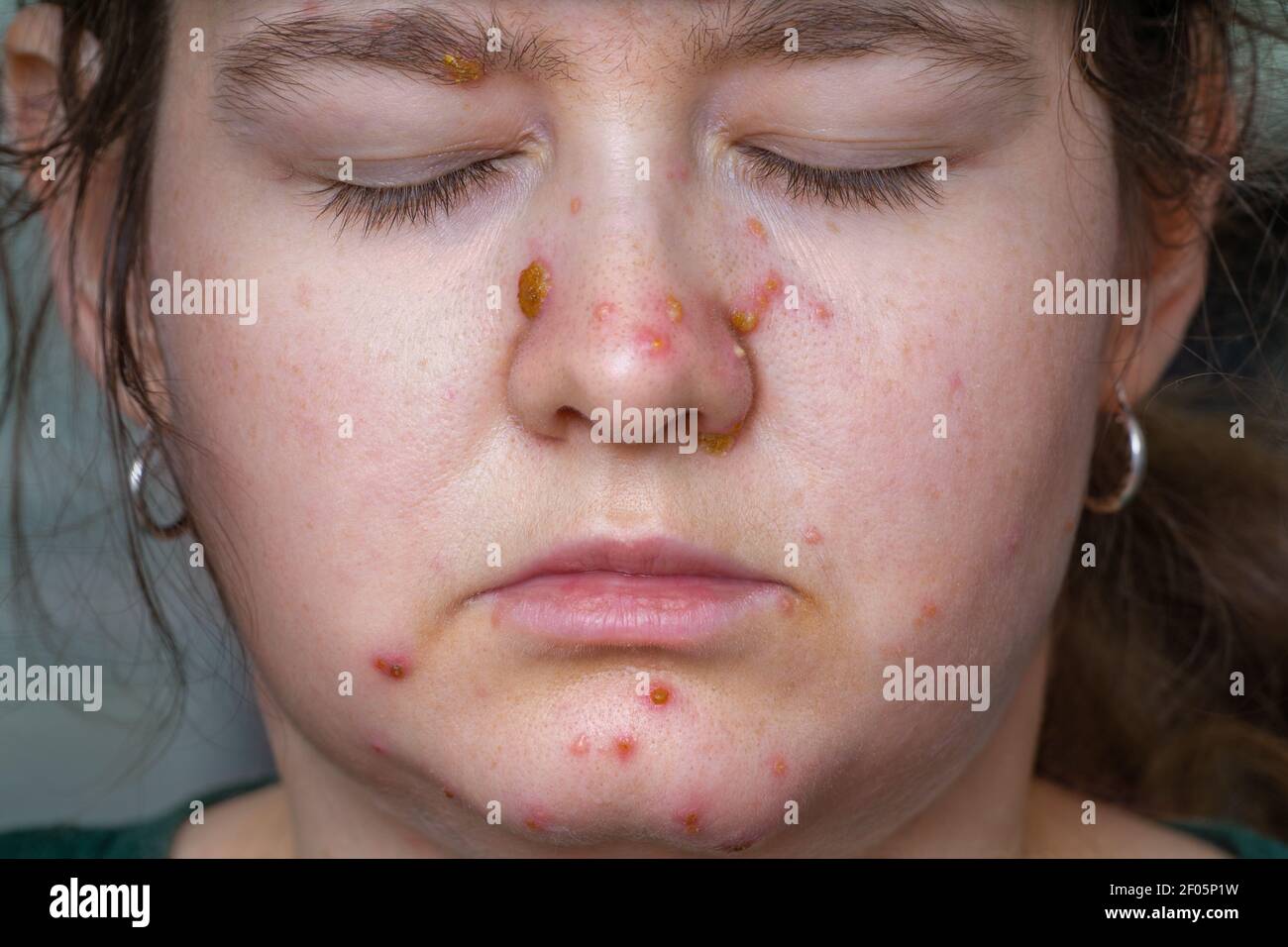 Smallpox Scars Adult