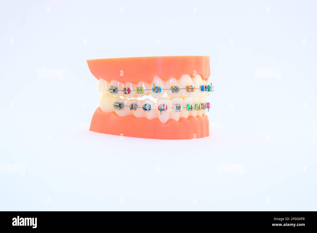 Orthodontic brackets hires stock photography and images Alamy