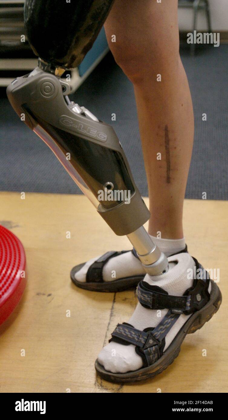 Deanna Babcock's left leg is a C-Leg model microprocessor-controlled knee  prosthetic made by Otto Bock on January 22, 2008, in Raleigh, North  Carolina. (Photo by Shawn Rocco/Raleigh News & Observer/MCT/Sipa USA Stock