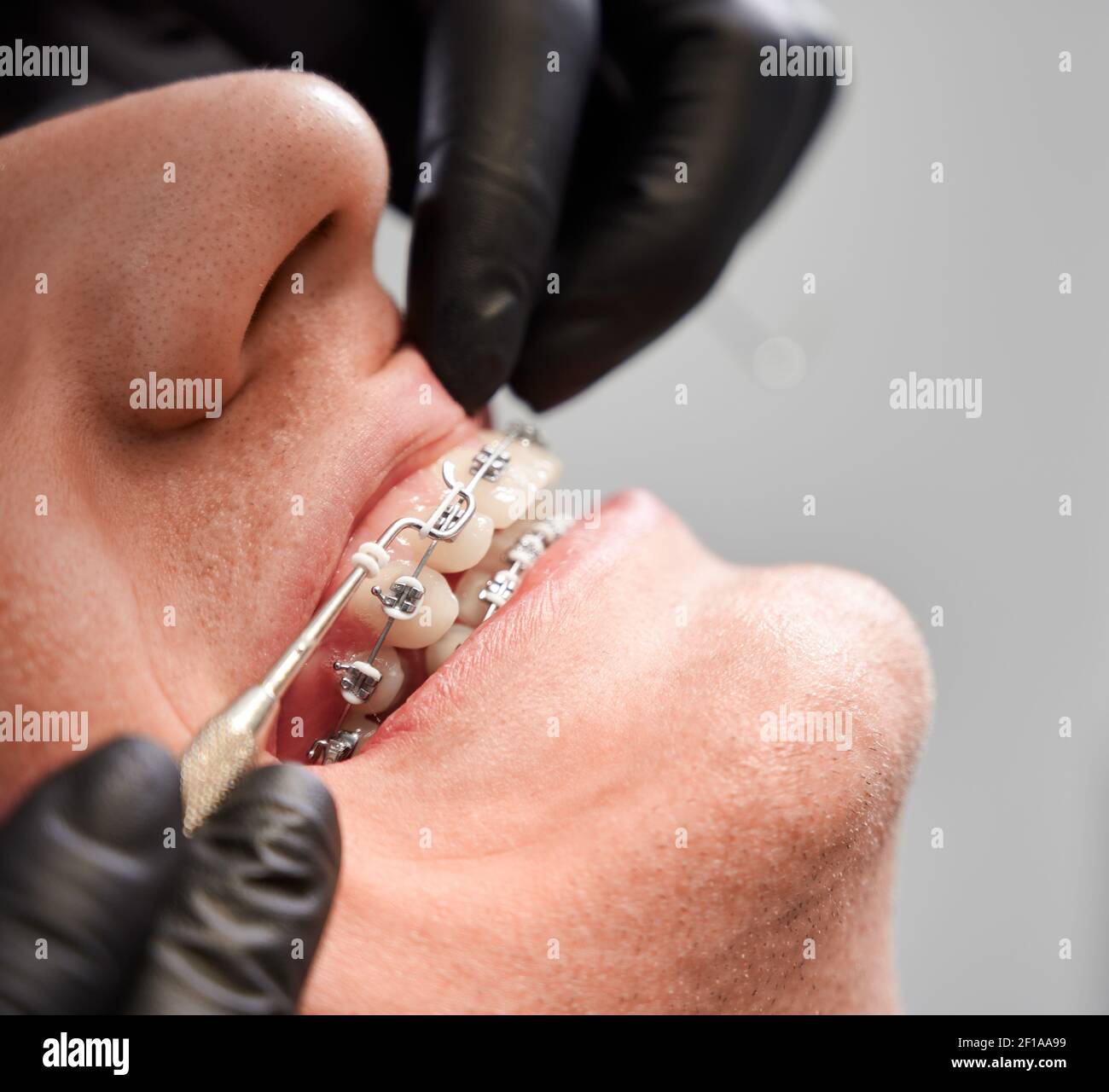 Close up of orthodontist hands putting elastic rubber band on patient brackets. Young man with wired metal braces on teeth receiving orthodontic treatment in dental clinic. Concept of dentistry. Stock Photo