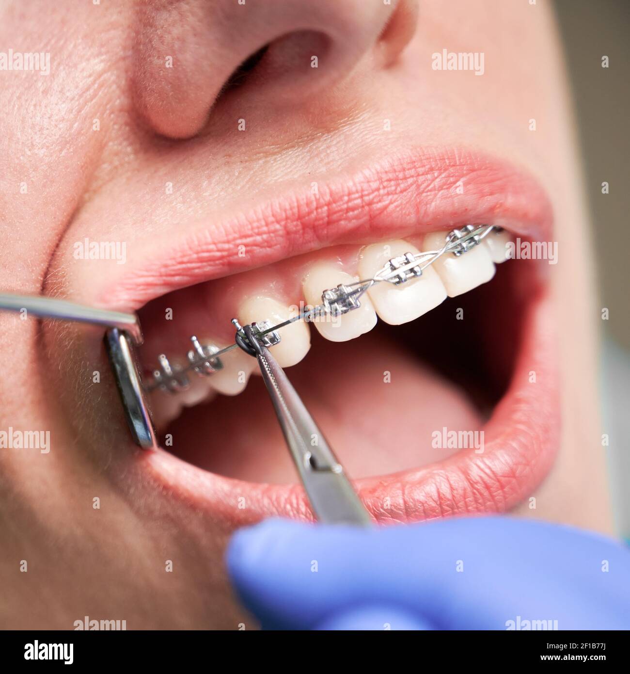 Close up of woman with brackets on white teeth. Orthodontist using