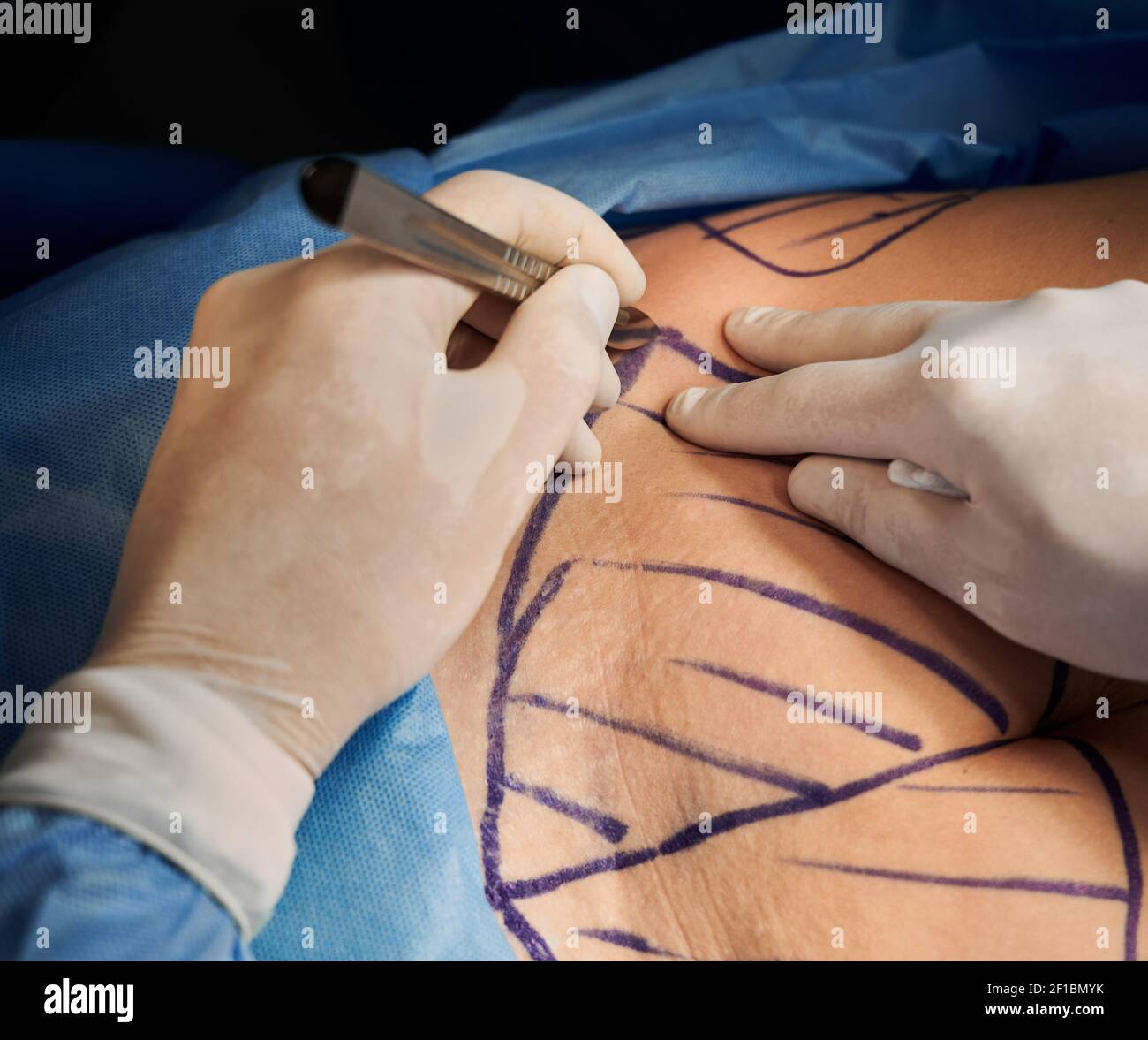 IPl or Intense Pulsed Light - Art of Plastic Surgery Fairfield CT