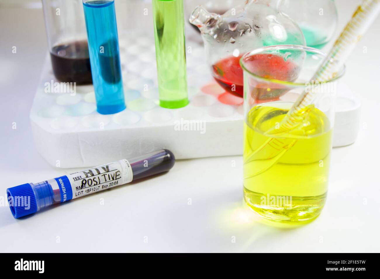 An HIV positive blood test tube on the table with beakers and flasks on