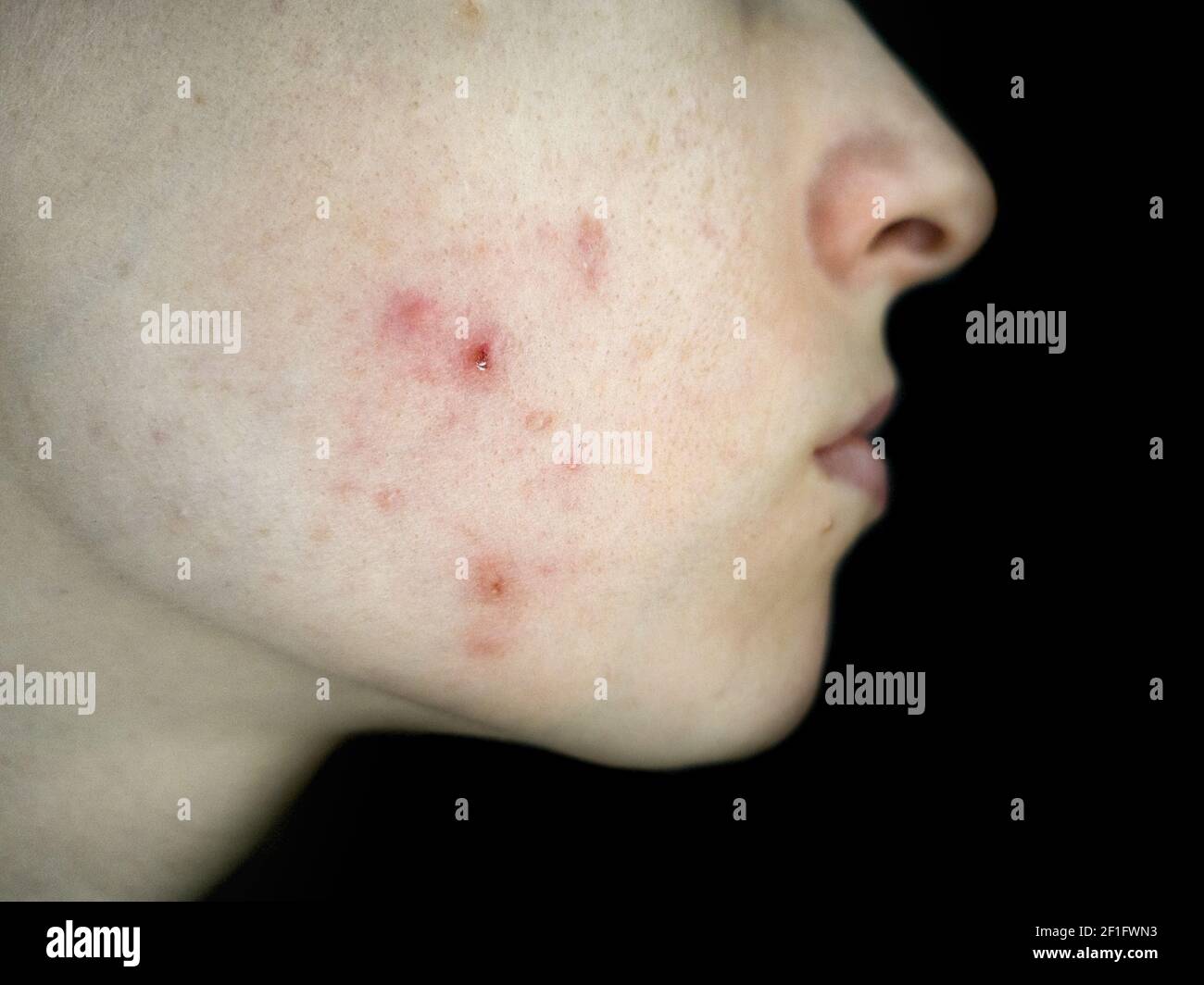 Close up of a woman cheek with acne red infection. Skin problem. Stock Photo