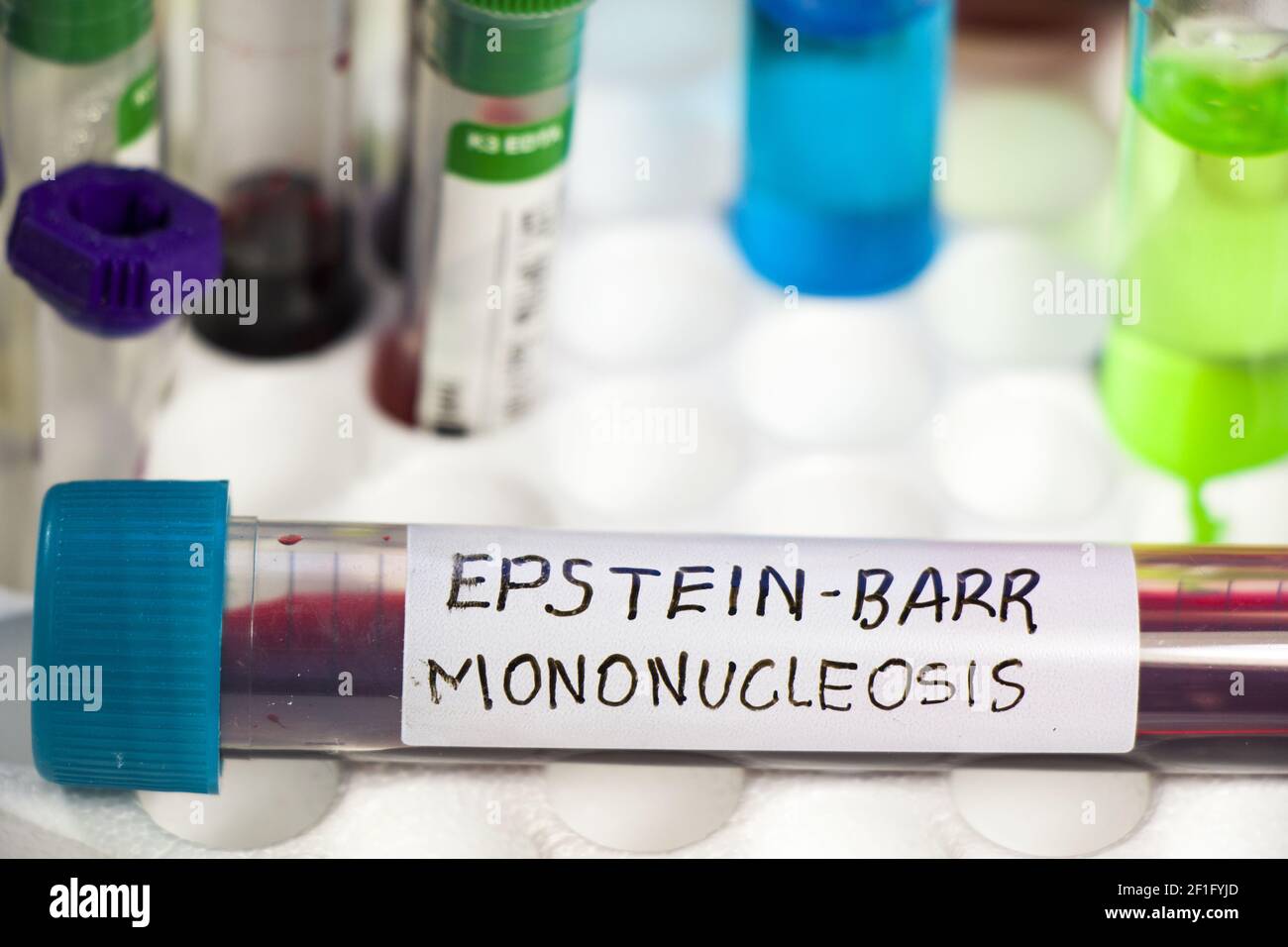 A closeup of an EPSTEIN-BARR virus test tube on the table in the ...