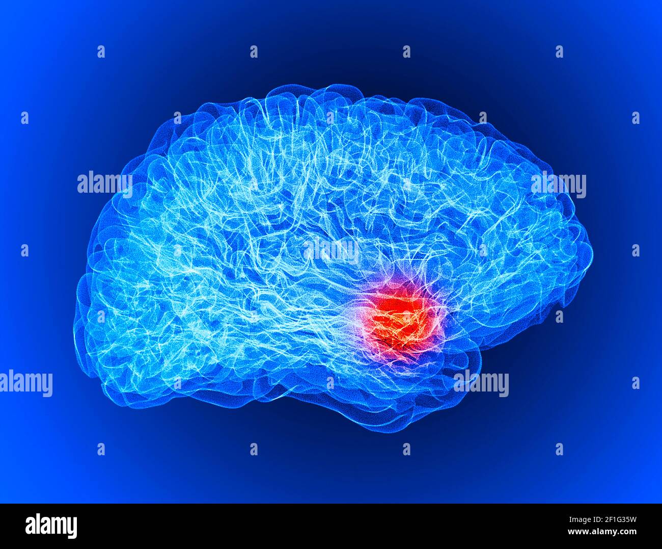 Pain in the head, brain and synapses, cognitive problems, mental deficit. Aneurysm. Degenerative diseases affecting the brain area. Parkinson, stroke Stock Photo