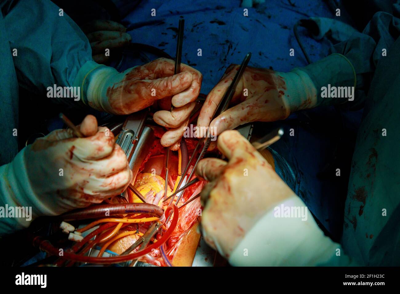 The hands of a medic surgeon is stitching a wound after an operation in hospital Stock Photo